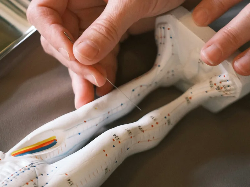 Acupuncture at Carroll Chiropractic in Westminster