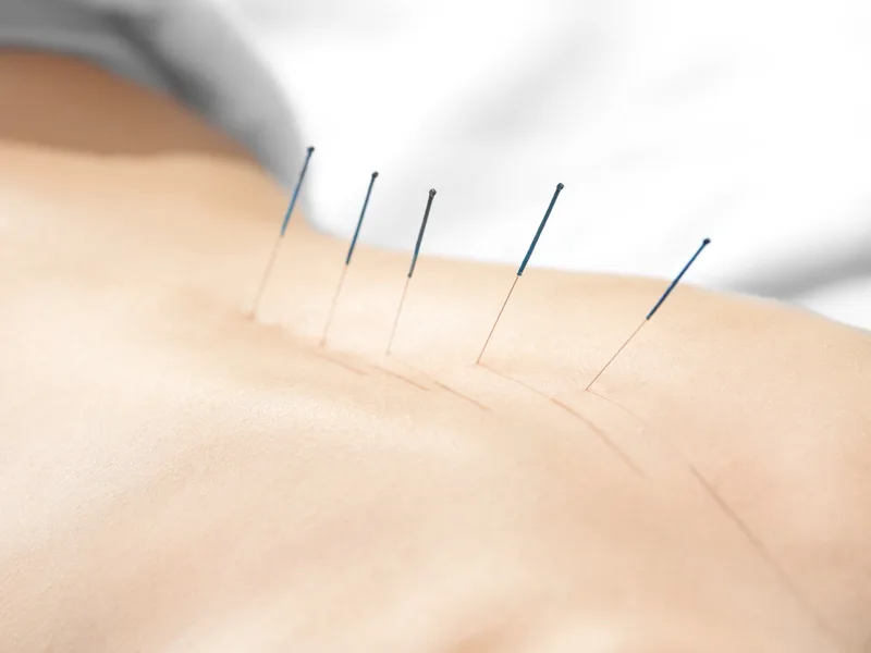 Acupuncture at Carroll Chiropractic in Westminster