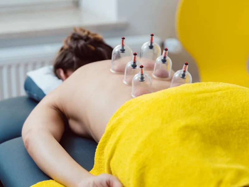 Cupping Therapy at Carroll Chiropractic in Westminster