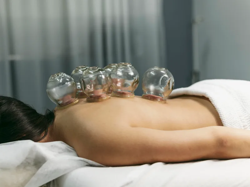 Cupping Therapy at Carroll Chiropractic in Westminster
