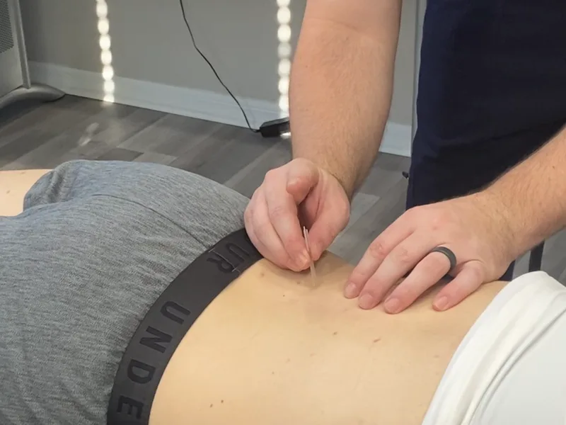 How Dry Needling works at Carroll Chiropractic