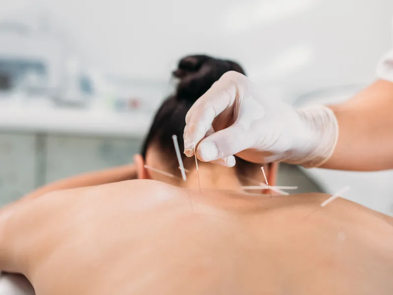 Dry Needling at Carroll Chiropractic in Westminster